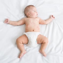 Baby mit Masern