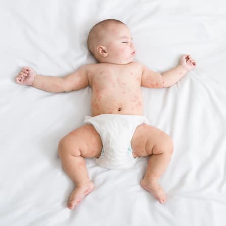Baby mit Masern Baby mit Masern
